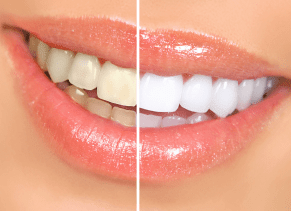 Teeth Whitening